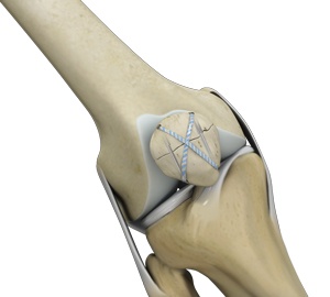 Knee Fracture Surgery Grafton | Knee Surgery Mequon, Milwaukee WI ...